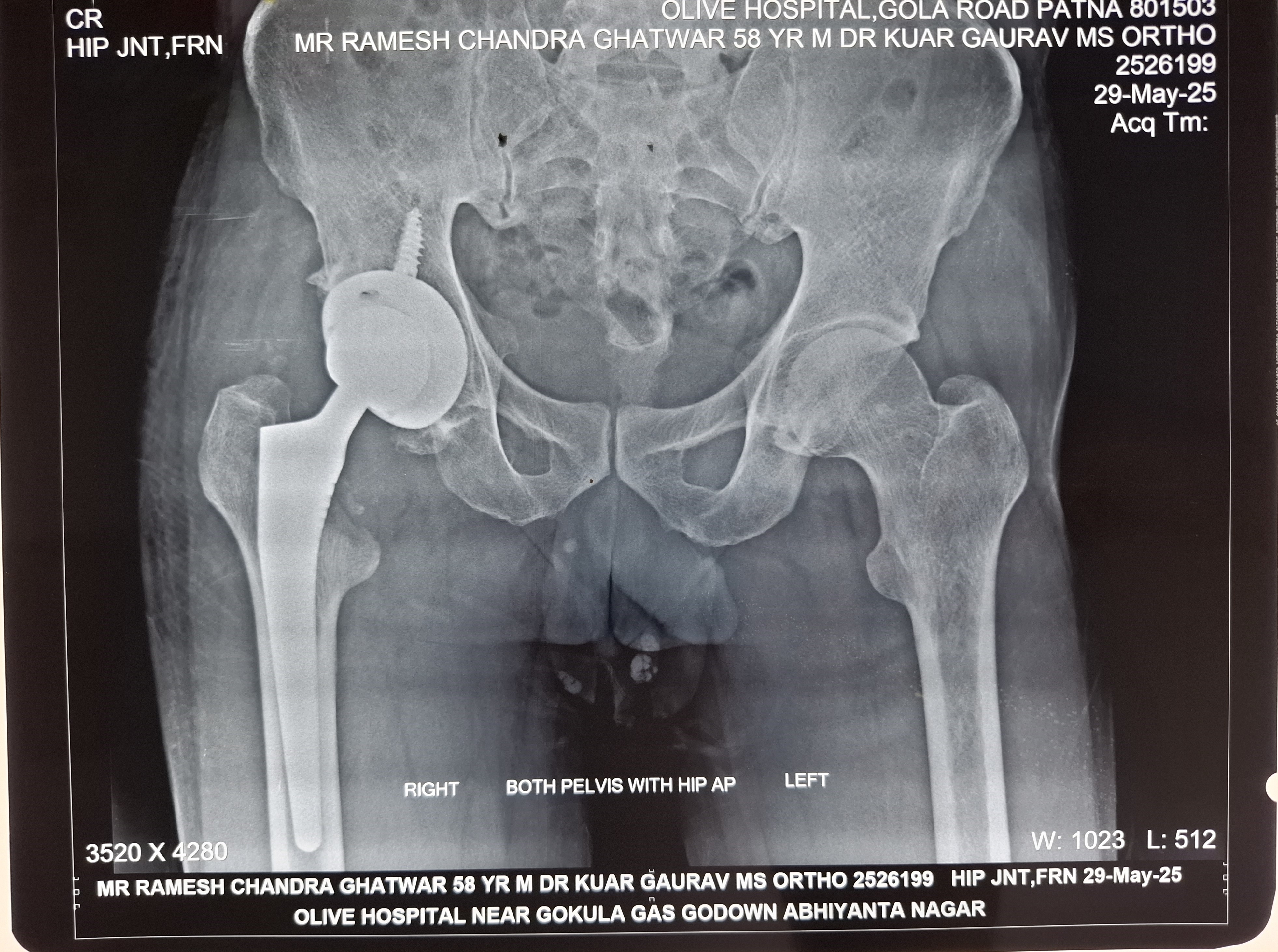 Ligament Surgeon in Patna- Olive Hospital - Dr Kumar Gaurav